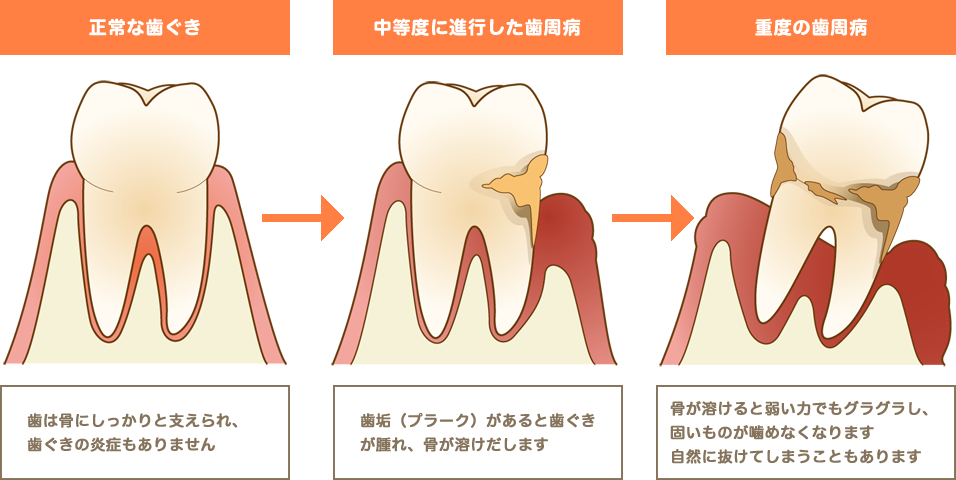 歯周病の治療